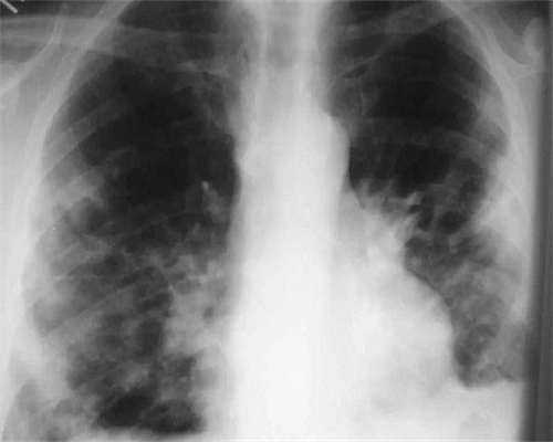 最佳代生网-做了显微取精的后遗症有哪些