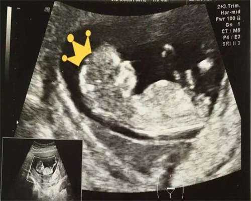 东莞三代试管婴儿助孕一般多少费用？